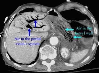 CT Scan of Ischemic Colitis