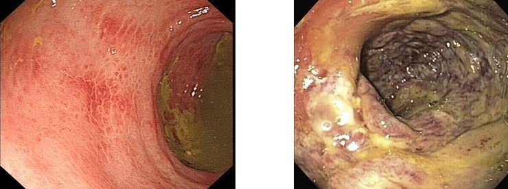 Ischemic Colitis on Endoscopy