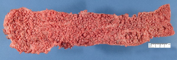 Familial Adenomatous Polyposis - Gross Specimen