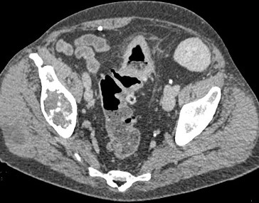 Sigmoid Colon Cancer with Bladder Invasion