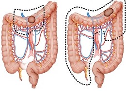 Extended Right Colon Resection