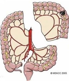 Left Colon Resection