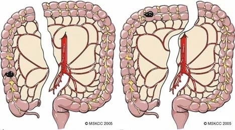 Right Colon Resection