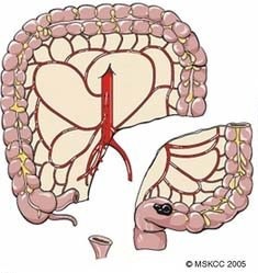 Sigmoid Colon Resection