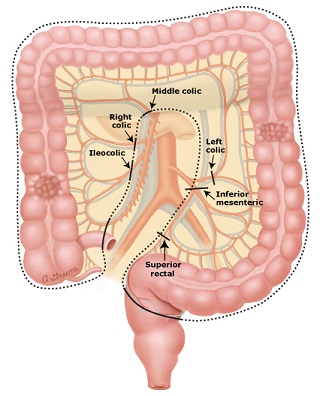 Subtotal Colon Resection