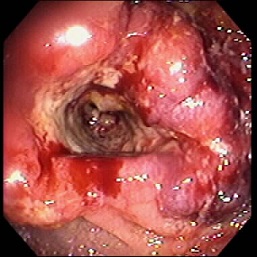 Sigmoid Colon Cancer - Endoscopy