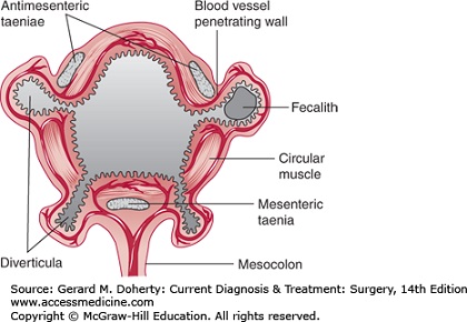 Colon Wall Diverticula