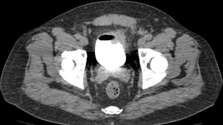 Colovesical Fistula