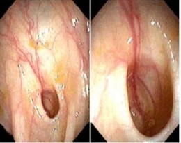 Blood Vessels Adjacent to a Colon Diverticulum