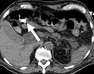 CT Angiogram of Acute Divertivular Bleeding