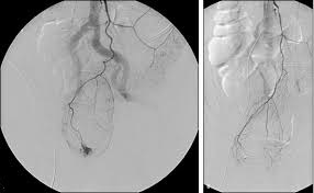 Angiogram of Acute Divertivular Bleeding