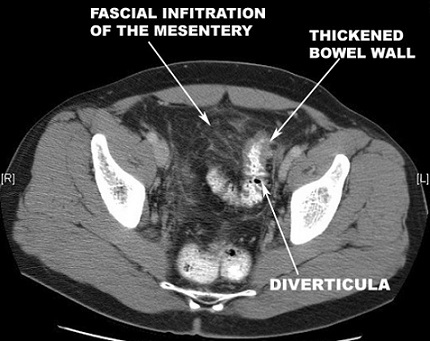 Acute Diverticulitis