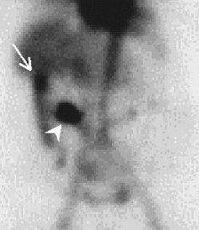 Tagged RBC ScanShowing Diverticular Bleeding