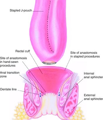 IPAA anastomoses