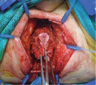 Perineal Portion of an Abdominoperineal Resection