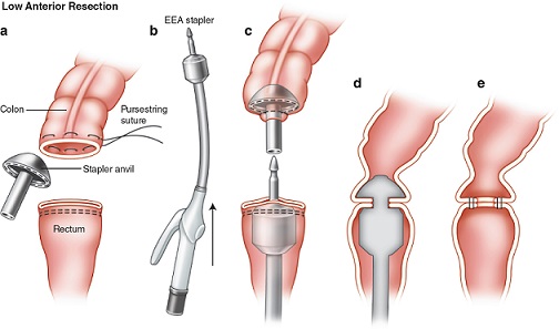 EEA Stapled Anastomosis