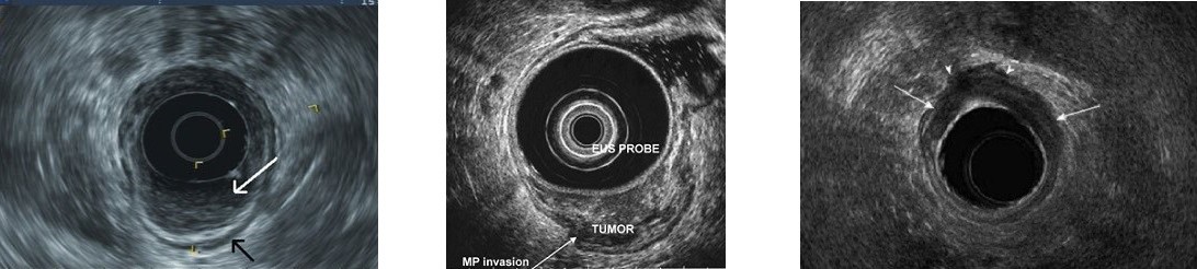 T-stages - Endorectal Ultrasound