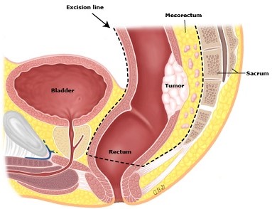 Total Mesorectal Excision