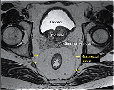 MRI - Mesorectal Fascia