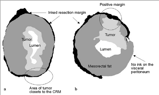 Circumferential Radial Margin