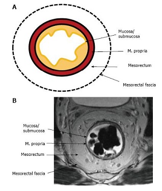 MRI - Mesorectum