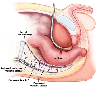 Presacral Fascia and Presacral Venous Plexus