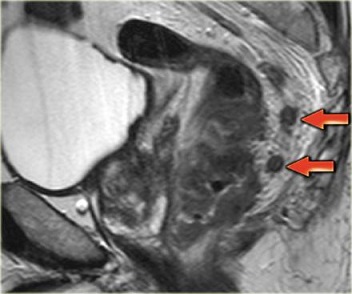 Suspicious Nodes - MRI