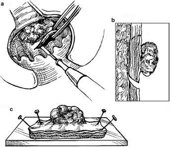 Transanal Excision - Rectal Cancer