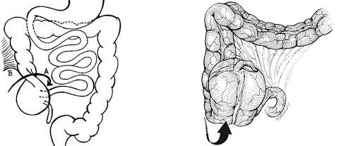 Cecal Volvulus - Axial Twist and Cecal Bascule