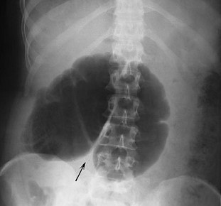 Cecal Volvulus - Abdominal X-ray