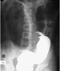 Sigmoid Volvulus - Birds Beak Sign