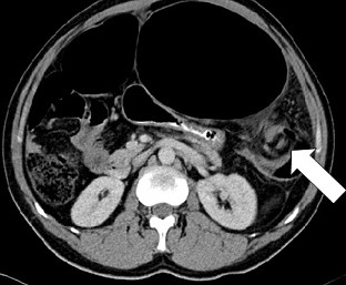 Sigmoid Volvulus - Whirl sign on CT Scan