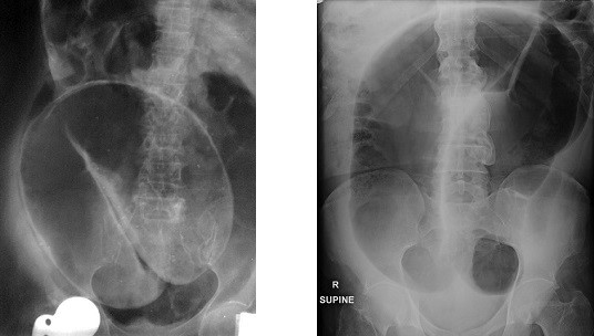 Sigmoid Volvulus - Bent Inner Tube Sign