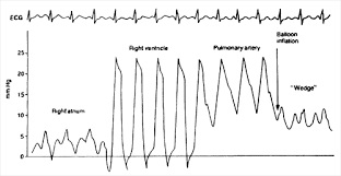 Swan-Ganz Catheter Tracing