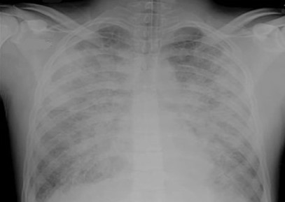 ARDS Chest X-ray