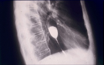 Benign GERD Stricture