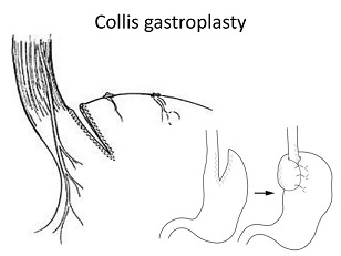 Collis Gastroplasty