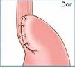 Dor 180 Degree Anterior Partial Fundoplication