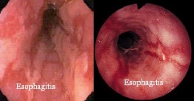 Esophagitis from GERD