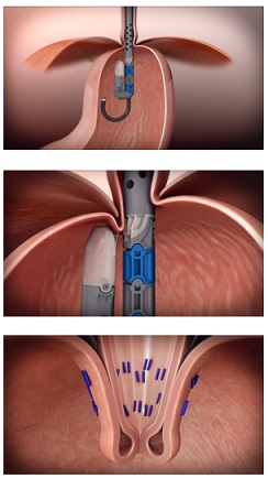 Exophyx Procedure