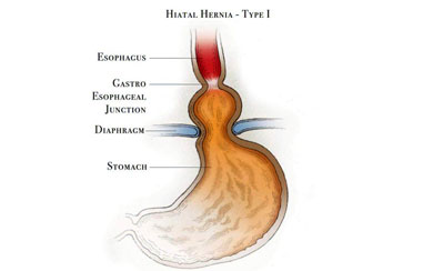 Type 1 Hiatal Hernia