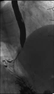 Esophageal Perforation after a Nissen Fundoplication