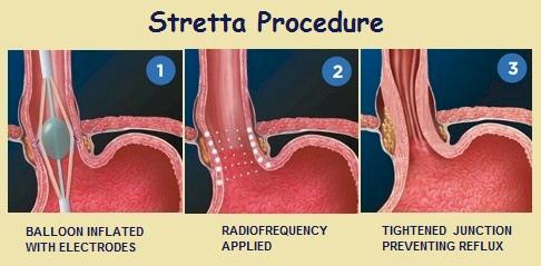 Stretta Procedure