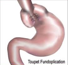 Toupet 270 Degree Partial Fundoplication