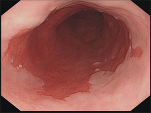 Barrett's Esophagus