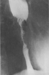 Esophagram showing a Malignant Stricture