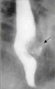 Gist Tumor of the Esophagus