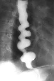 Barium Swallow Demonstrating a Corkscrew Esophagus