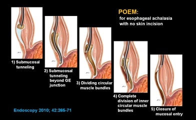 Per Oral Endoscopic Myotomy