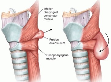 Zenkers Diverticulum